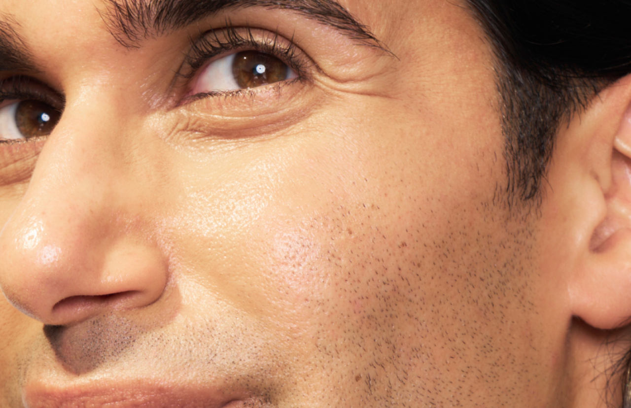 Close-up of SKINVIVE™ patient Adam’s eye and cheek, with his skin looking smooth and radiant. 
