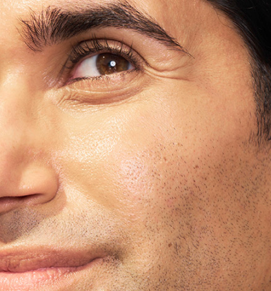 Close-up of SKINVIVE™ patient Adam’s eye and cheek, with his skin looking smooth and radiant.